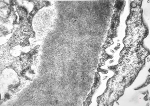 M,22y. | type II membranoproliferative glomerulonephritis M,22y. | type II membranoproliferative glomerulonephritis